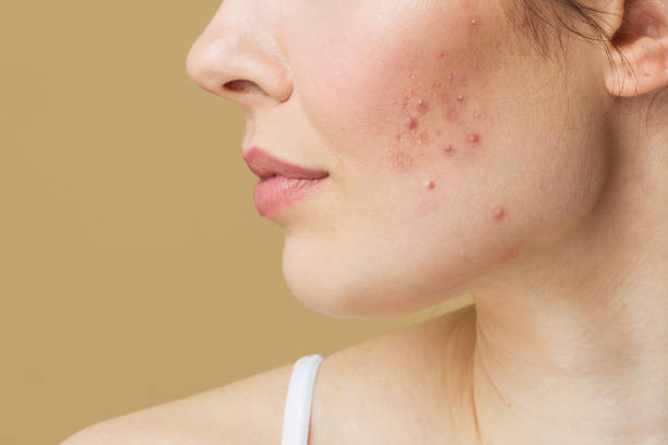 Young woman before and after acne treatment. Skin care concept