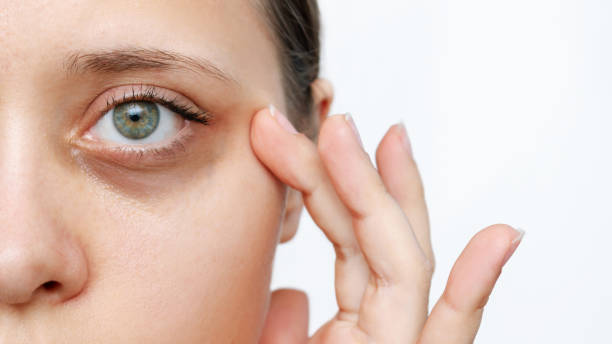 A young caucasian woman demonstrating dark circles under her eyes with hand isolated on a white background. Pale skin, bruises under the eyes are caused by fatigue, lack of sleep, insomnia and stress